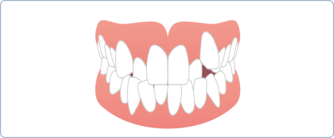  矯正歯科が必要な代表的な噛み合わせ
